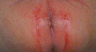 Itchy rash anus