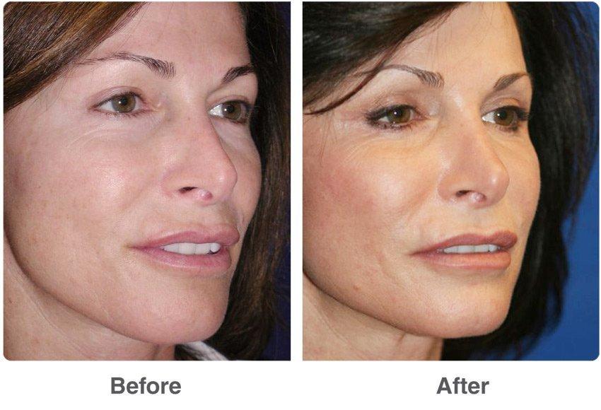 Lightening B. reccomend Facial laser procedure