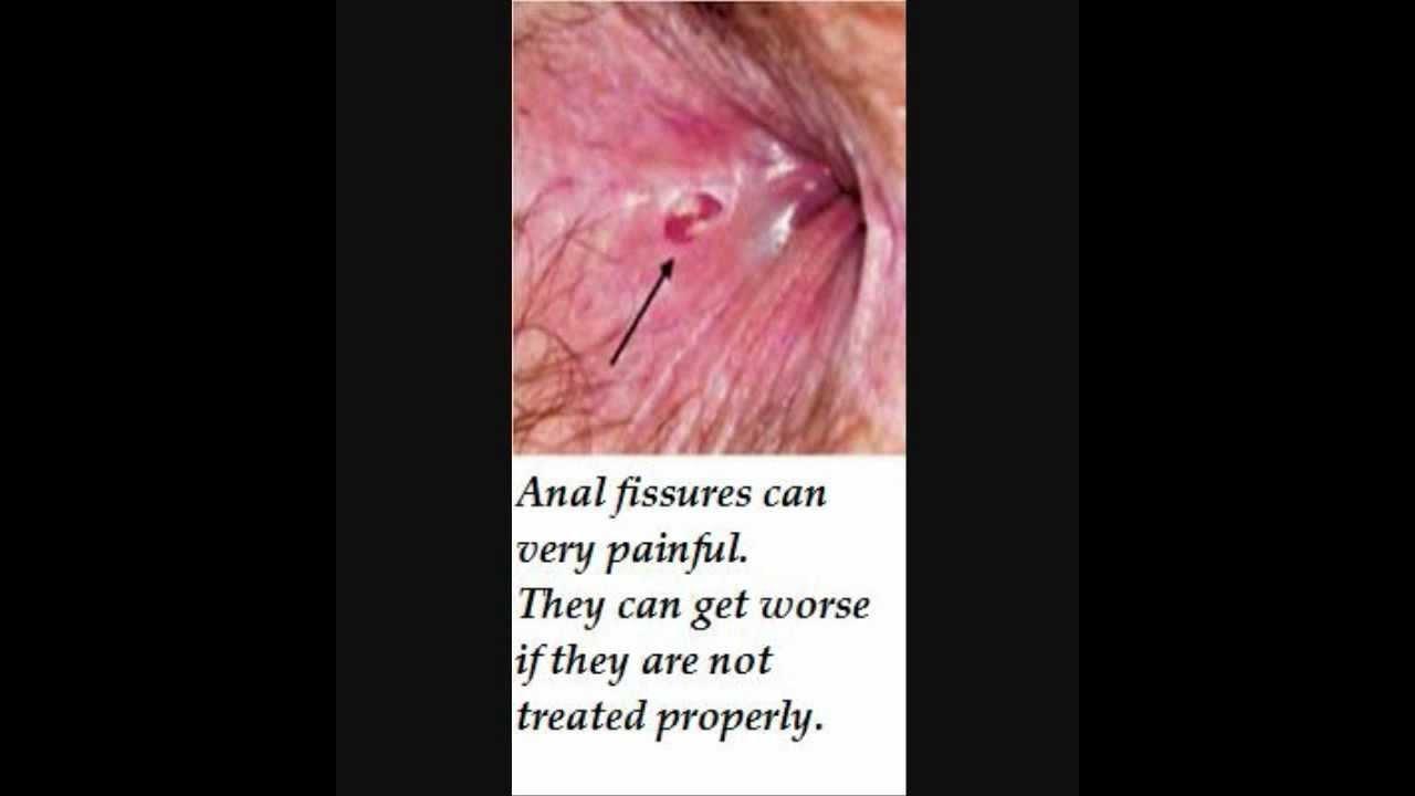 Open sore near anus pic