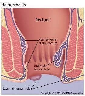 Anus pain bowel movements