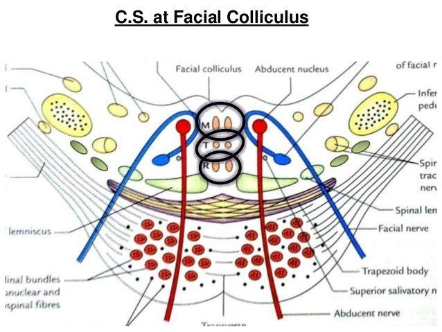 best of Syndrome Facial colliculus