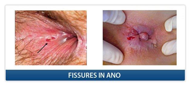 best of Fissure symptom Anal