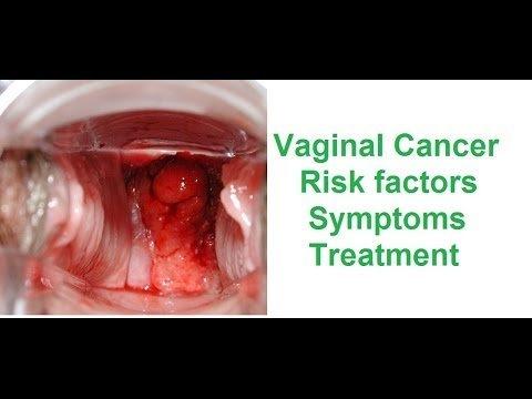 best of Vagina Adenocarcinoma of