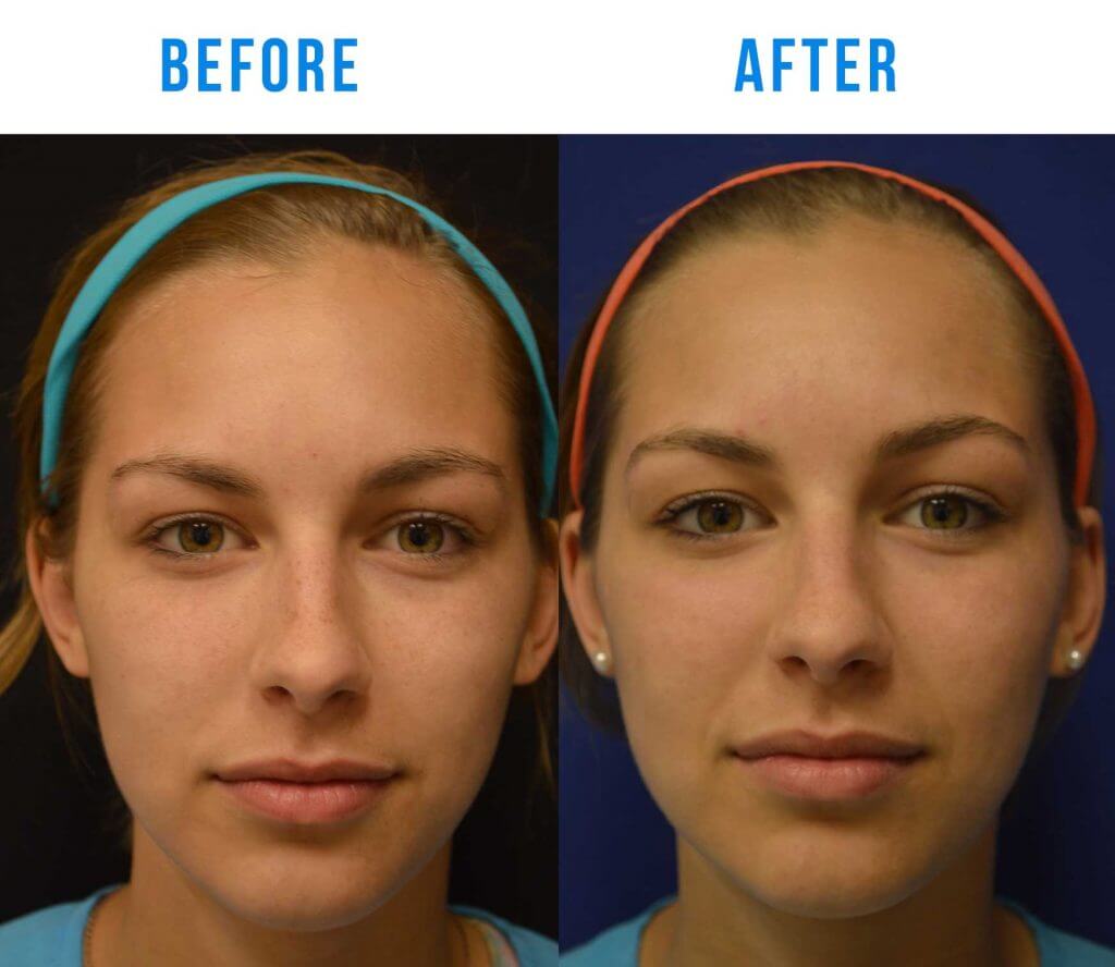 Facial rejuvination photo sun spots