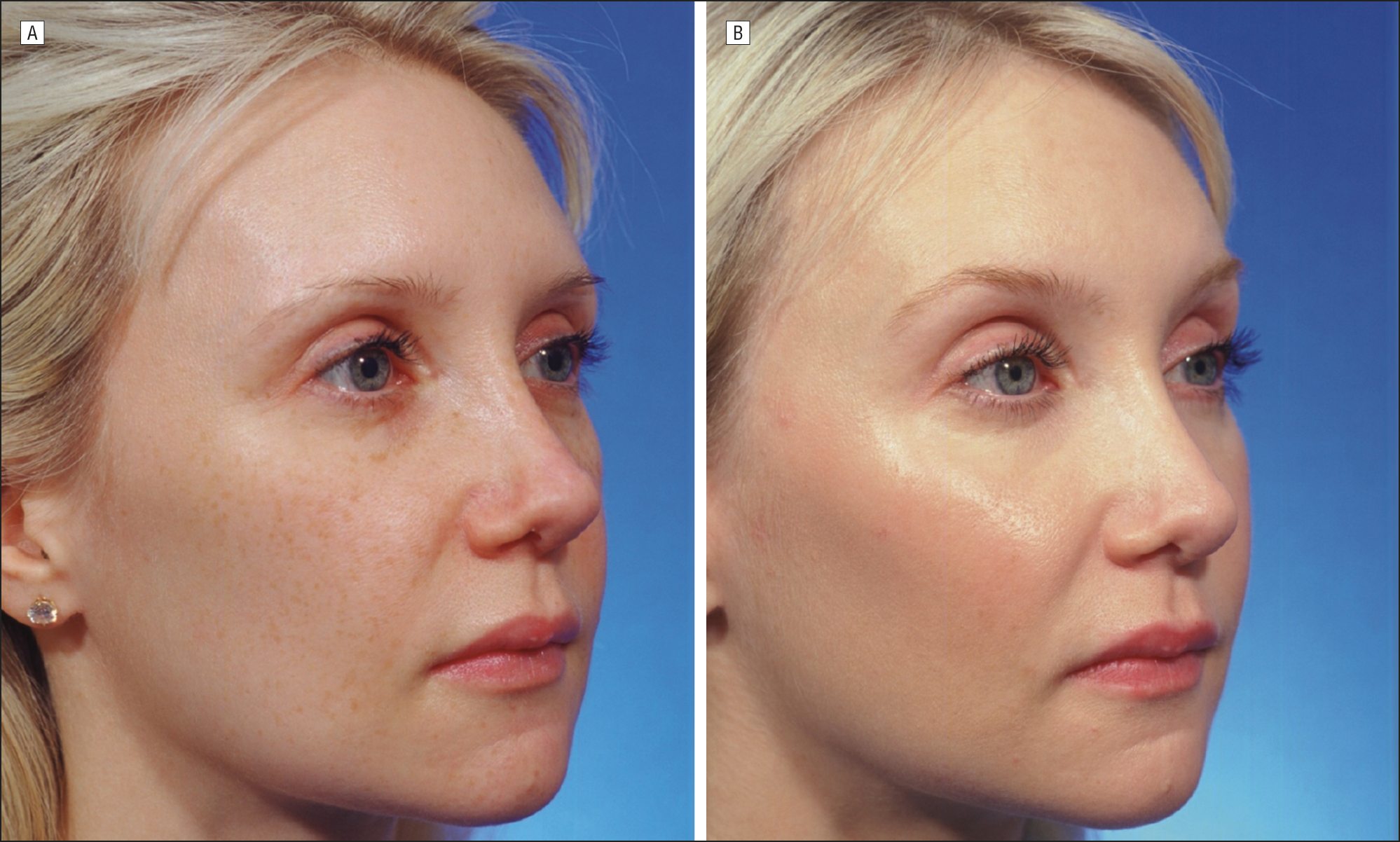 Facial laser procedure