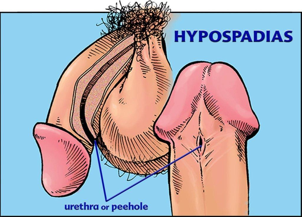 Cloudburst reccomend Hypospadias affecting sperm delivery