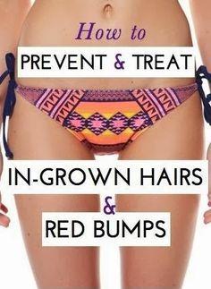 best of Razor bikini Preventing burn/bikini bumps when area shaving
