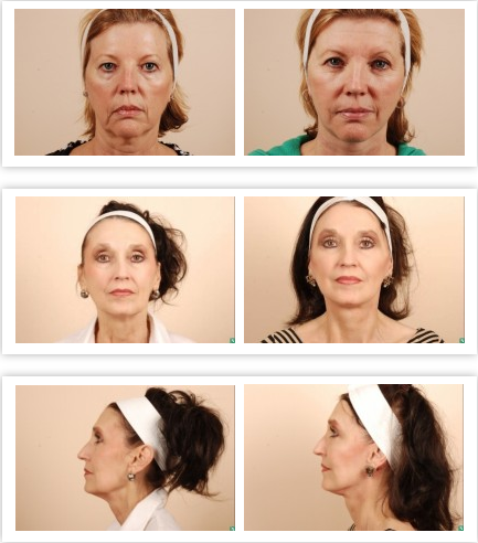 Duchess reccomend Cost facial plastic surgery