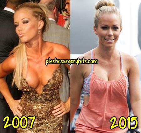 Southpaw reccomend Kendra wilkinson with out boob job