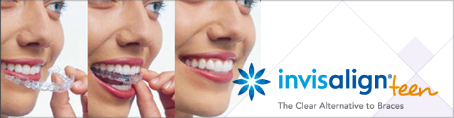 best of Teen the clear Invisalign