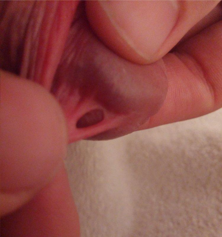 Hole in side of penis