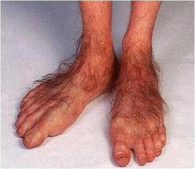 Engineer reccomend Ugly feet fetish