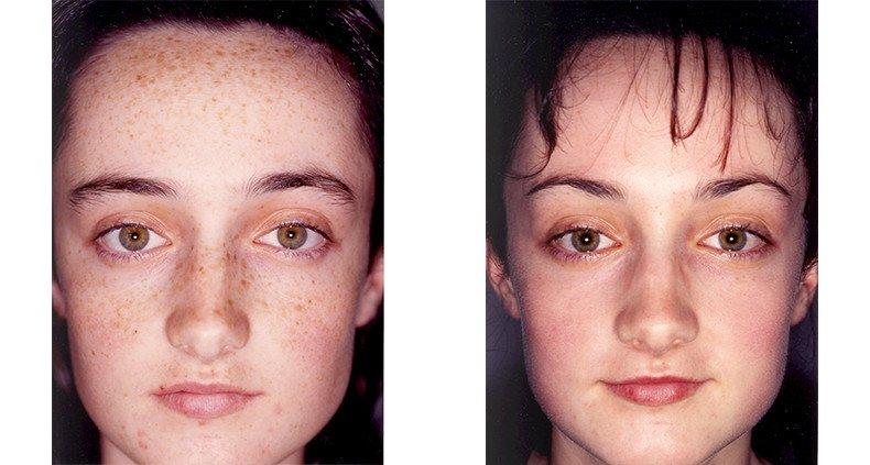 best of Damage caused peels Skin by facial