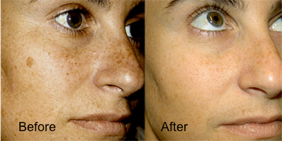 Treatments facial sunspots