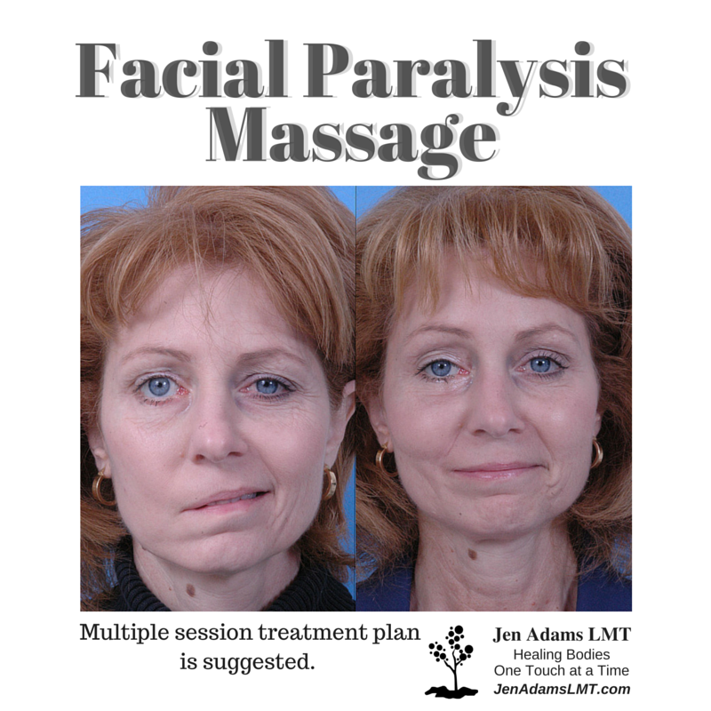 Wonder W. reccomend Facial paralysis stroke