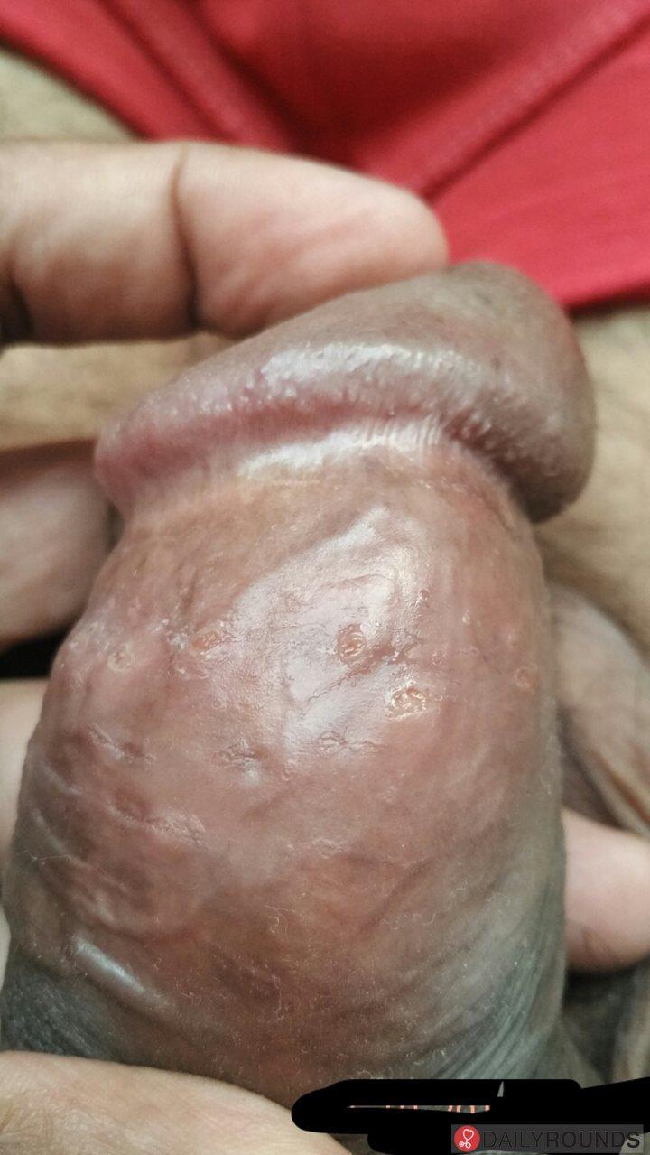 best of Wart hand penis Genital
