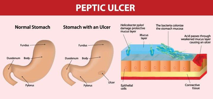 best of Penetration Peptic ulcer