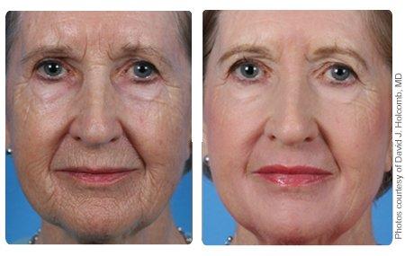 The B. reccomend Facial laser procedure