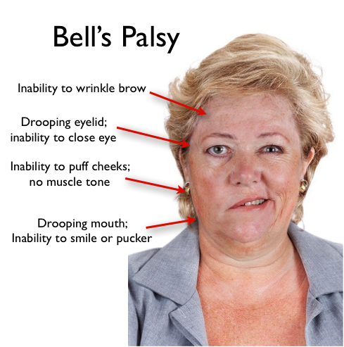 best of Facial paralysis Sudden