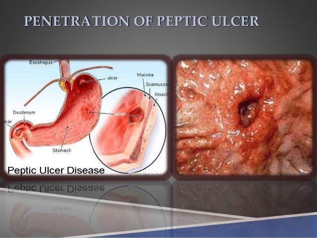 Peptic ulcer penetration