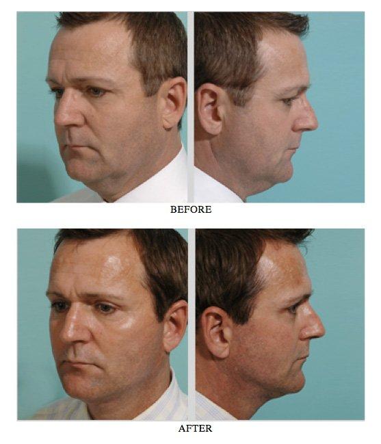 Lord P. S. reccomend Facial male plastic surgery