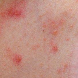 best of Anus Itchy rash