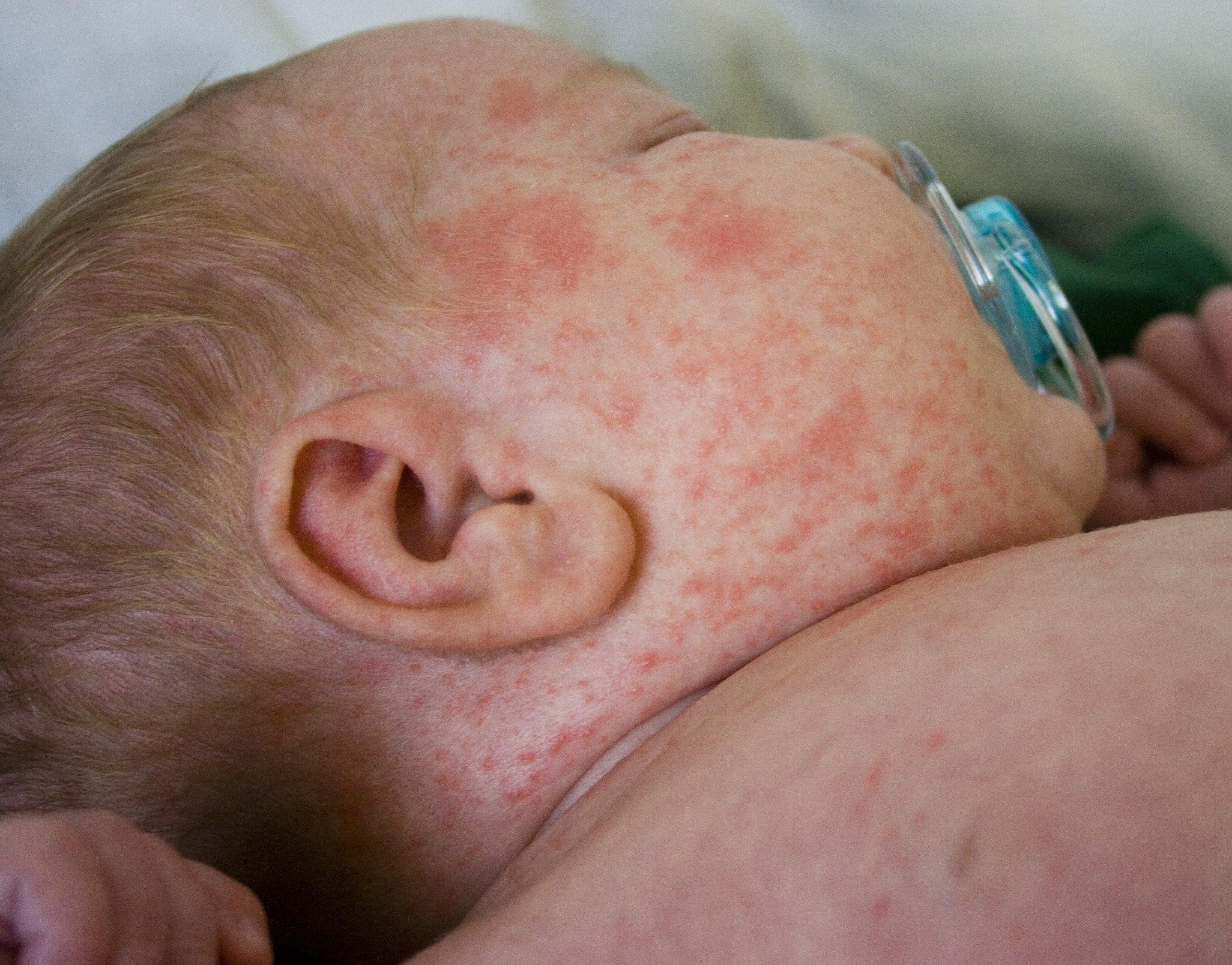 Rubble reccomend Treating newborn facial rash