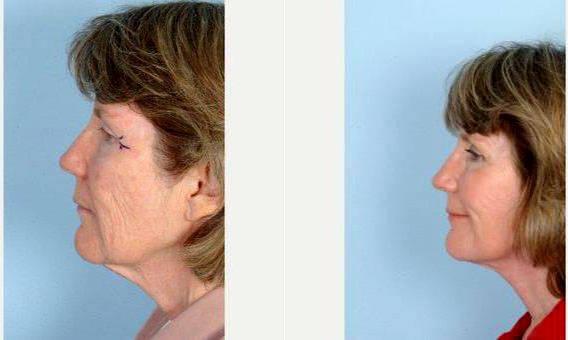 Zee-donk reccomend Facial plastic surgeons seattle