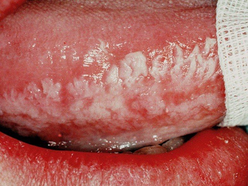best of Hairy cause Oral leukoplakia