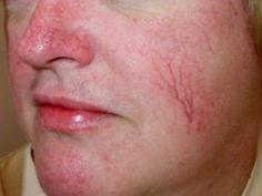 Mositurizers and facial spider veins
