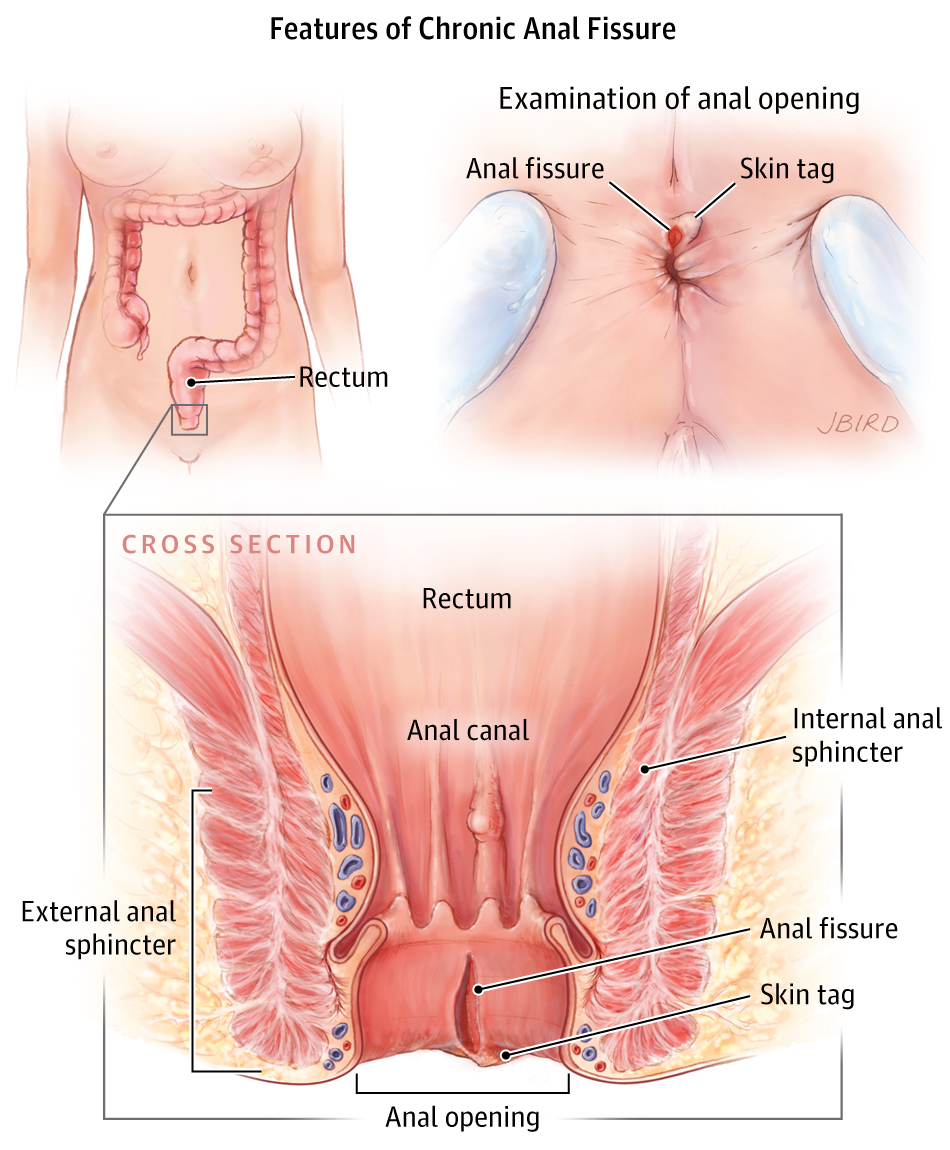 Anal fissure signs