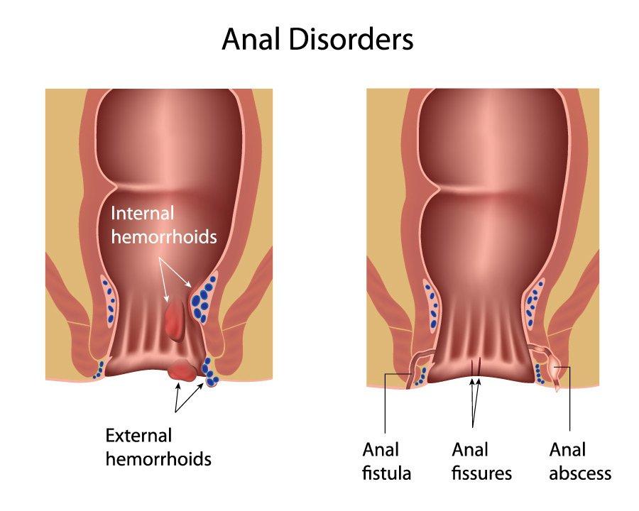 Anal fissure signs