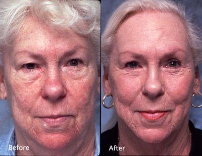 best of Toning exercises facial Free