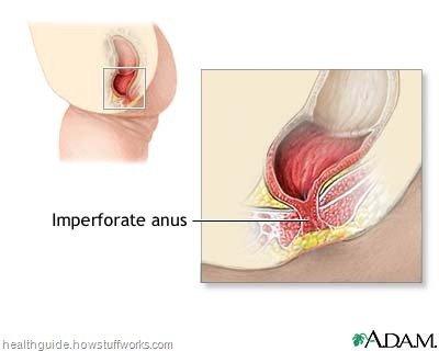 best of Imperforated Definition anus of