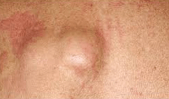 Fourth D. reccomend Lump on anus wont go away