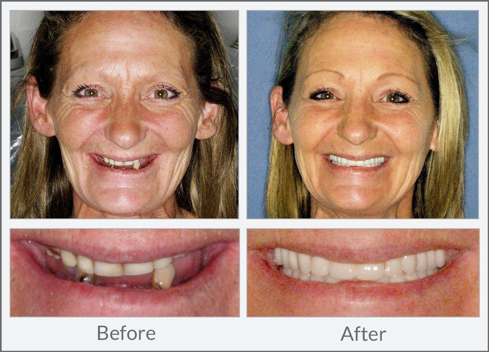 Facial appearance with dentures