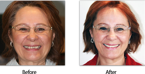 best of Dentures Facial appearance with