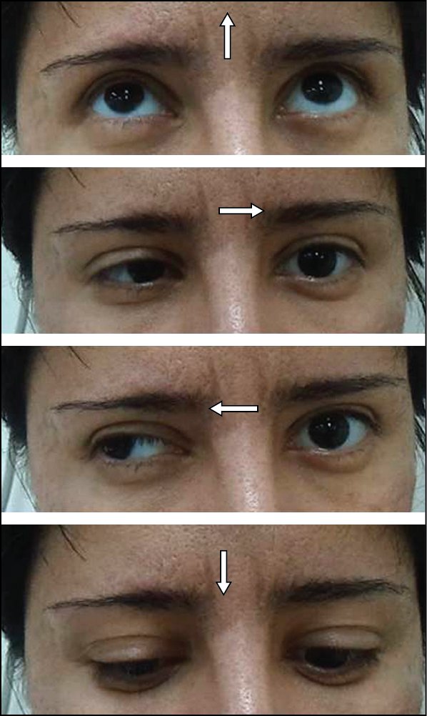 Infiniti reccomend Facial colliculus syndrome