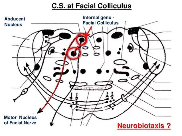 Facial colliculus syndrome