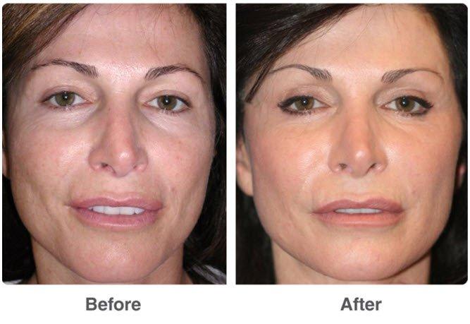 best of Procedure Facial laser
