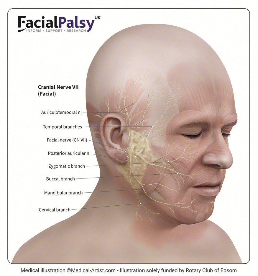 best of Paralysis stroke Facial
