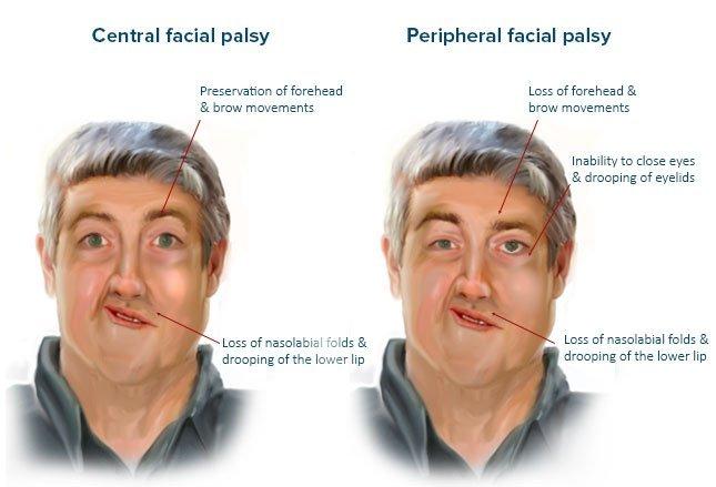 Stats reccomend Facial paralysis stroke