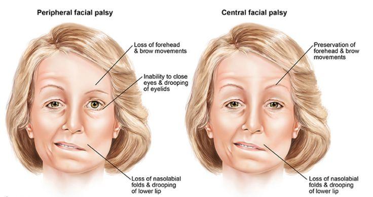 Half facial paralysis - Nude gallery