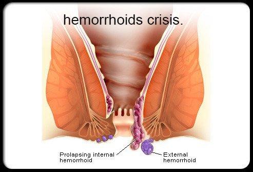 best of To Hemorrhoids anal sex due