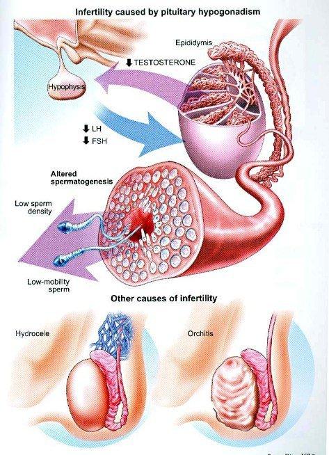 Hypospadias affecting sperm delivery