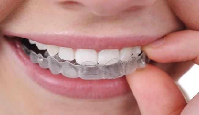 Invisalign teen effectively straightens teeth