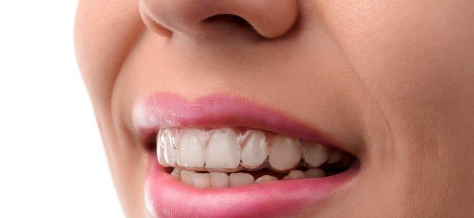 best of Teen effectively straightens teeth Invisalign