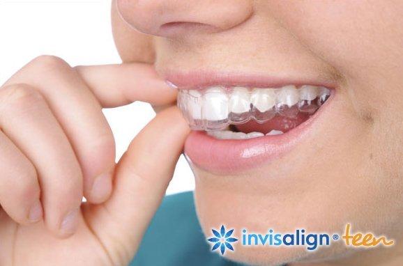 Mustang reccomend Invisalign teen the clear