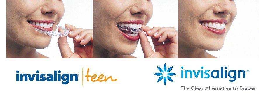 Invisalign teen the clear