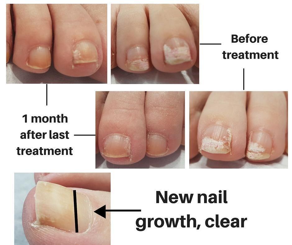 Nail fungus treatment nail penetration menthol